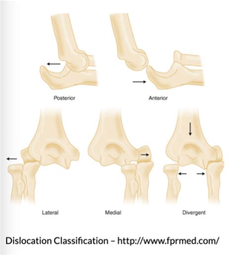 Types Of Elbow Dislocation