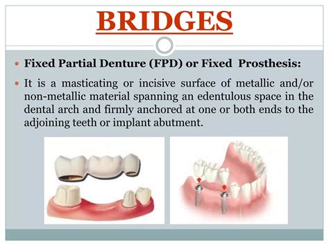 Types Of Fixed Prosthodontics