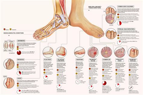 Types Of Foot Diseases