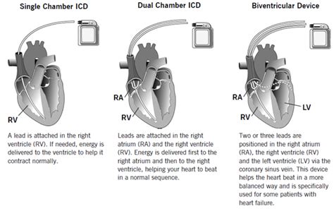 Types Of Icd Device