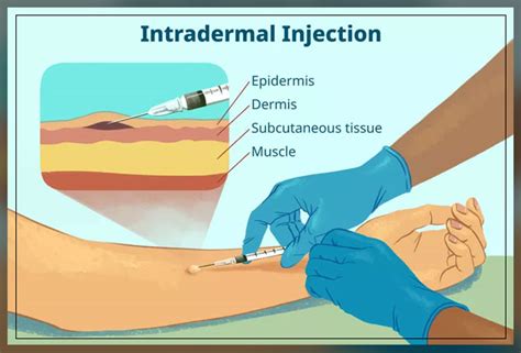 types of intradermal injection