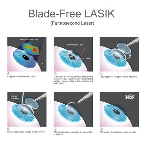 types of laser eye procedures