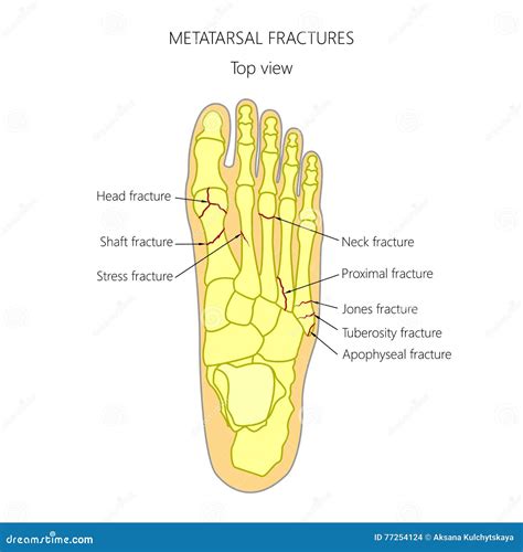 Types Of Metatarsal Fractures