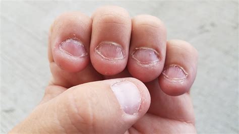 Types Of Nail Biting