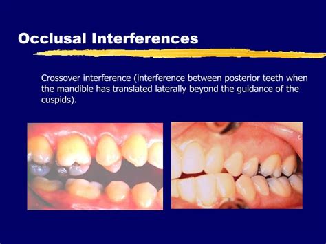 Types Of Occlusal Interference