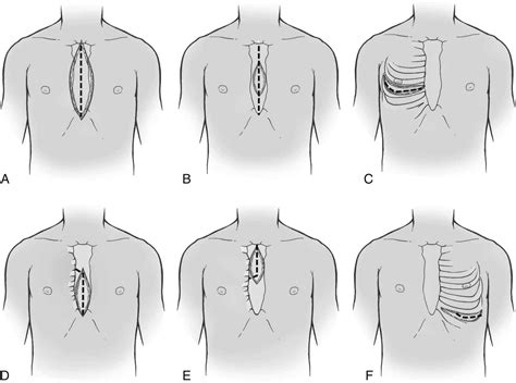 Types Of Open Chest Surgery