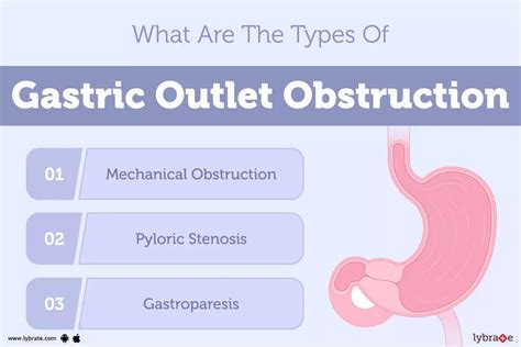 Types Of Outlet Obstruction