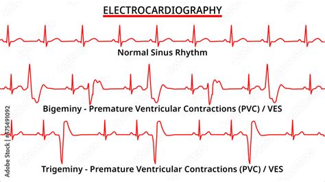 Types Of Pvc Heart Rhythm