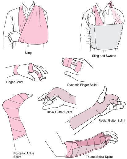 Types Of Splints For Fractures
