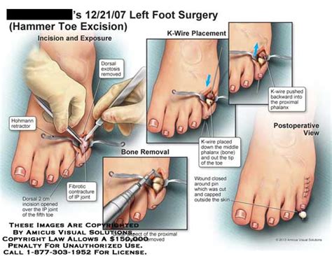 Types Of Toe Surgery