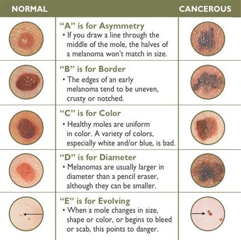 types skin cancers