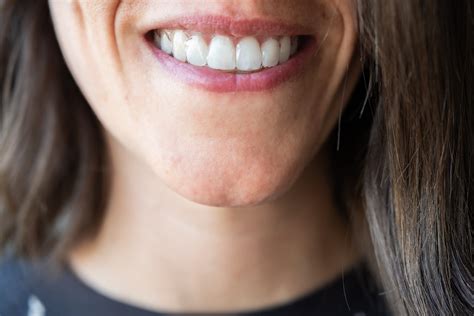 typical time frame for invisalign