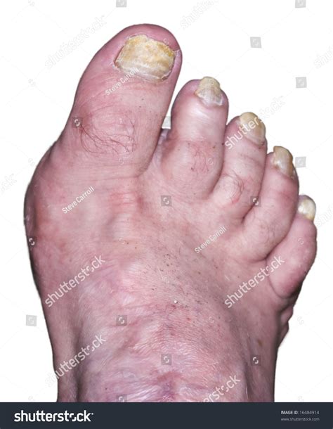 Ugly Foot