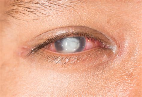Understanding and Managing an Ulcer on Eye: Causes, Symptoms, and Effective Treatments