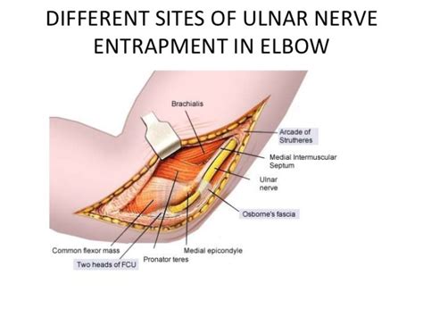 Ulnar Nerve Surgery: Effective Relief from Chronic Pain