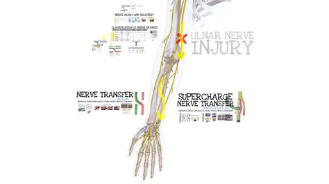 Ulnar Nerve Transposition Splint