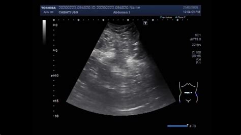 ultrasonido de hernia umbilical