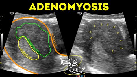 ultrasound findings of adenomyosis
