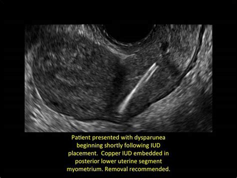 ultrasound guided iud insertion