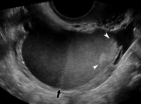 ultrasound images of endometrioma