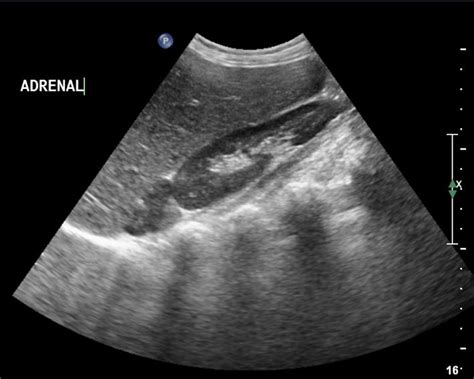 ultrasound of adrenal gland