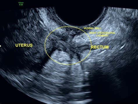 ultrasound treatment for endometriosis