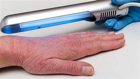 ultraviolet red light therapy