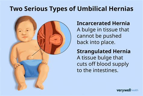 Understanding Umbilical Hernia Operations: What You Need to Know About Surgery and Recovery