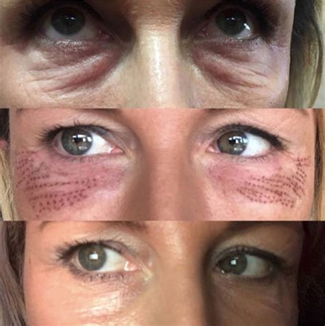 Laser For Under Eye Wrinkles Before And After ScienceHUB
