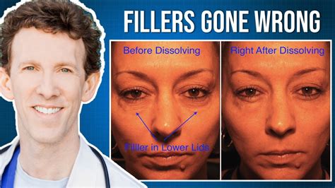 under eye fillers gone wrong