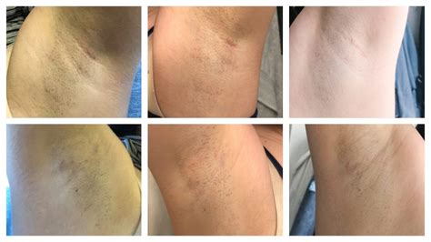 underarm laser hair removal how many sessions