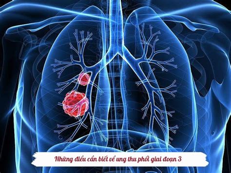 ung thư phổi giai đoạn 3