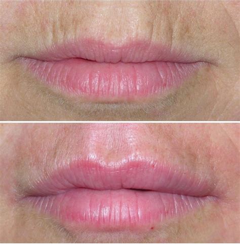 Upper Lip Wrinkles Before And After: Tips And Tricks To A Youthful Look