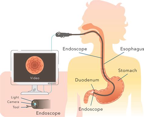 Understanding Upper GI Endoscopy: A Diagnostic Lifesaver