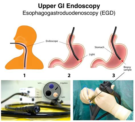 Upper Gi Endoscopy For Acid Reflux
