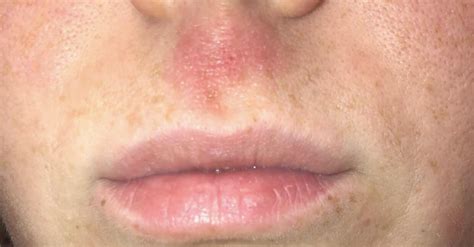 Upper Lip Eczema Reddit