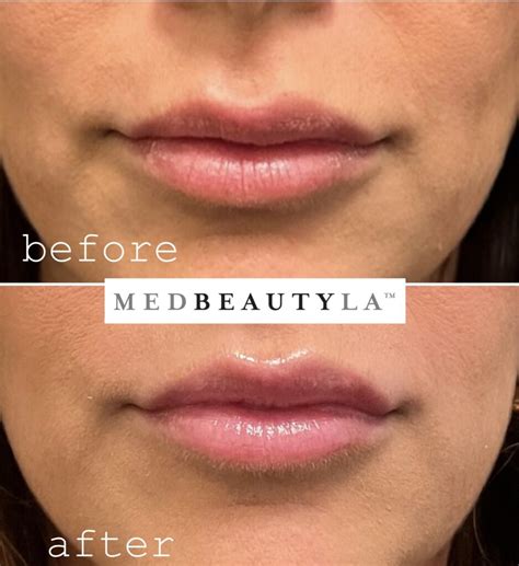 Upper Lip Enhancement Options