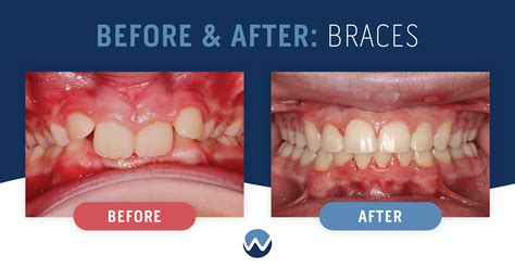Upper Teeth Braces Before And After