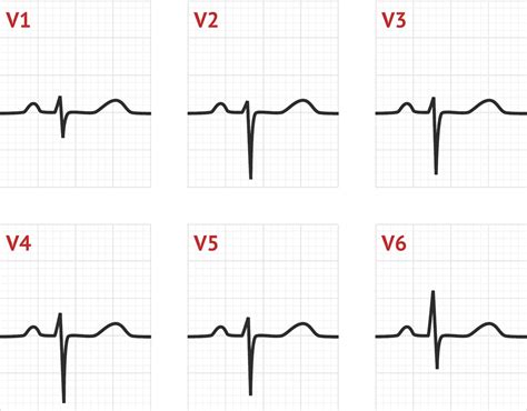 upside down qrs complex