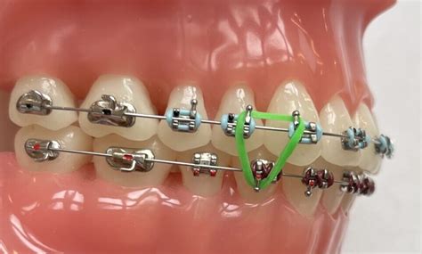 Upside Down Triangle Elastics Braces