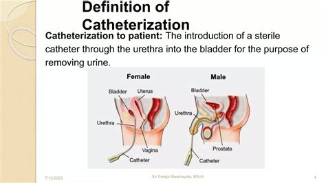 Ureteral Catheterization Definition