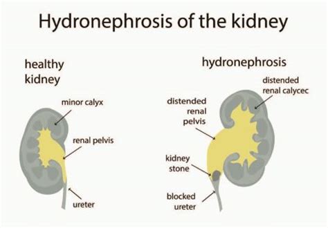 Unraveling the Mystery: Understanding Ureterolithiasis ICD 10 - A Comprehensive Guide