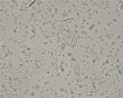 Urinalysis Squamous Epithelial Cells