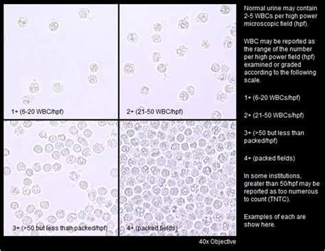 Urinalysis Wbc
