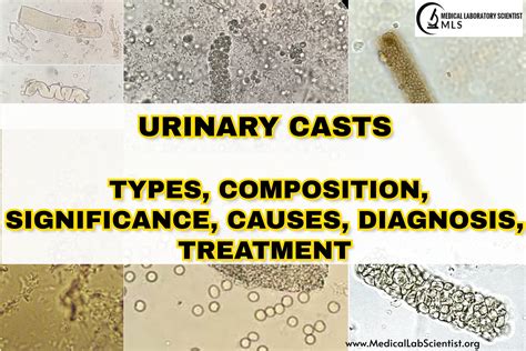 Urinary Hyaline Casts Uncovered: Causes and Insights Explained