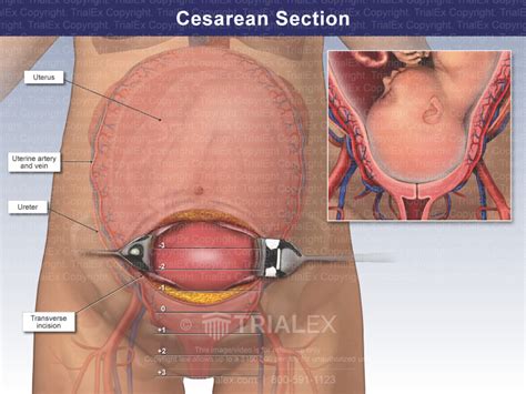 Urine Bag During C Section