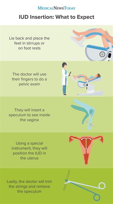 us guided iud insertion