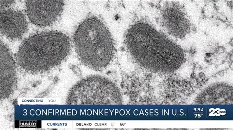 us monkeypox cases cdc
