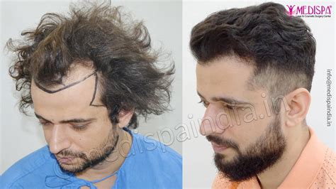 usa hair transplant cost