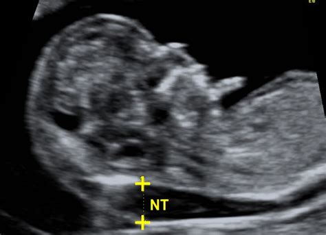 Unlocking Fetal Health: The Importance of USG NT Scan